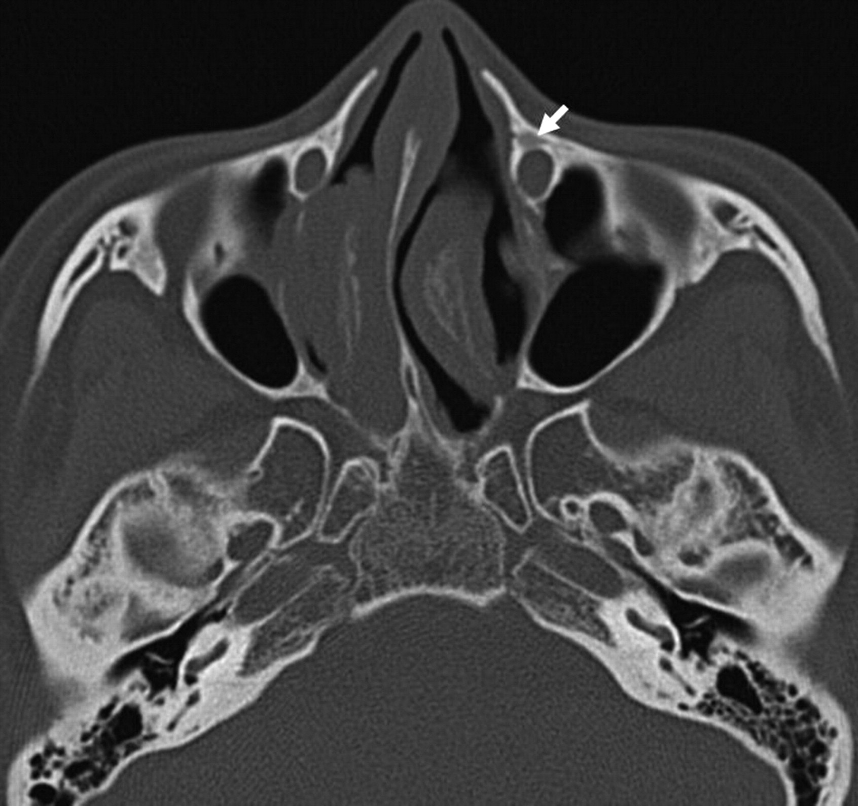 CT Maxilla