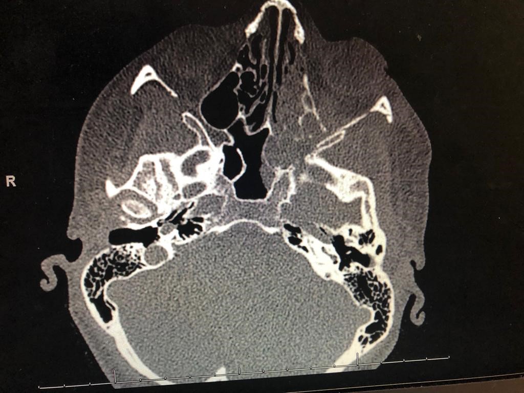 CT Maxillofacial