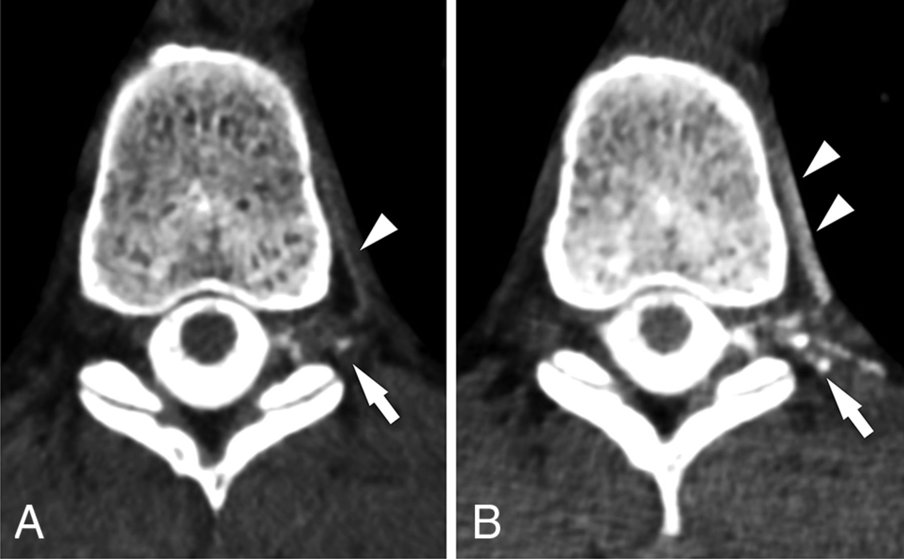 CT Myelogram