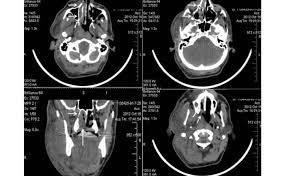 CT Nasopharynx & Base of Skull