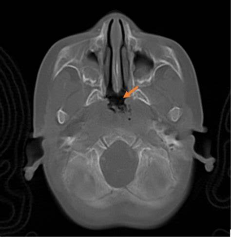 CT Nasopharynx & Base of Skull