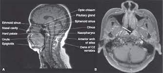 CT Nasopharynx