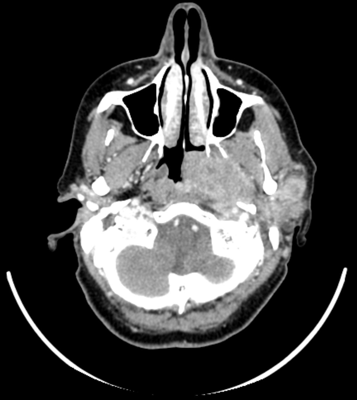 CT Nasopharynx