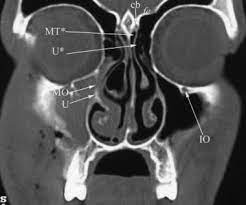 CT Para Nasal Sinuses (Limited)