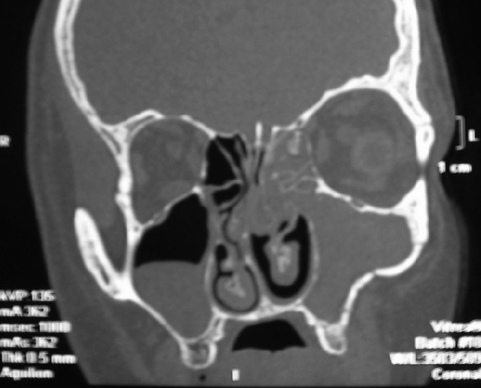 CT Para Nasal Sinuses (Limited)