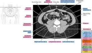 CT Pelvis