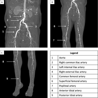 CT Peripheral Angiography - Lower Extremity