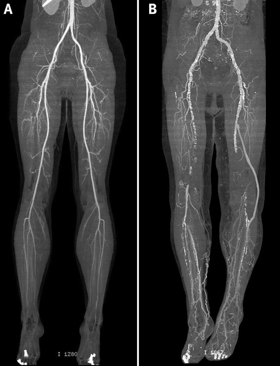 CT Peripheral Angiography - Lower Extremity