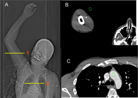 CT Peripheral Angiography - Upper Extremity