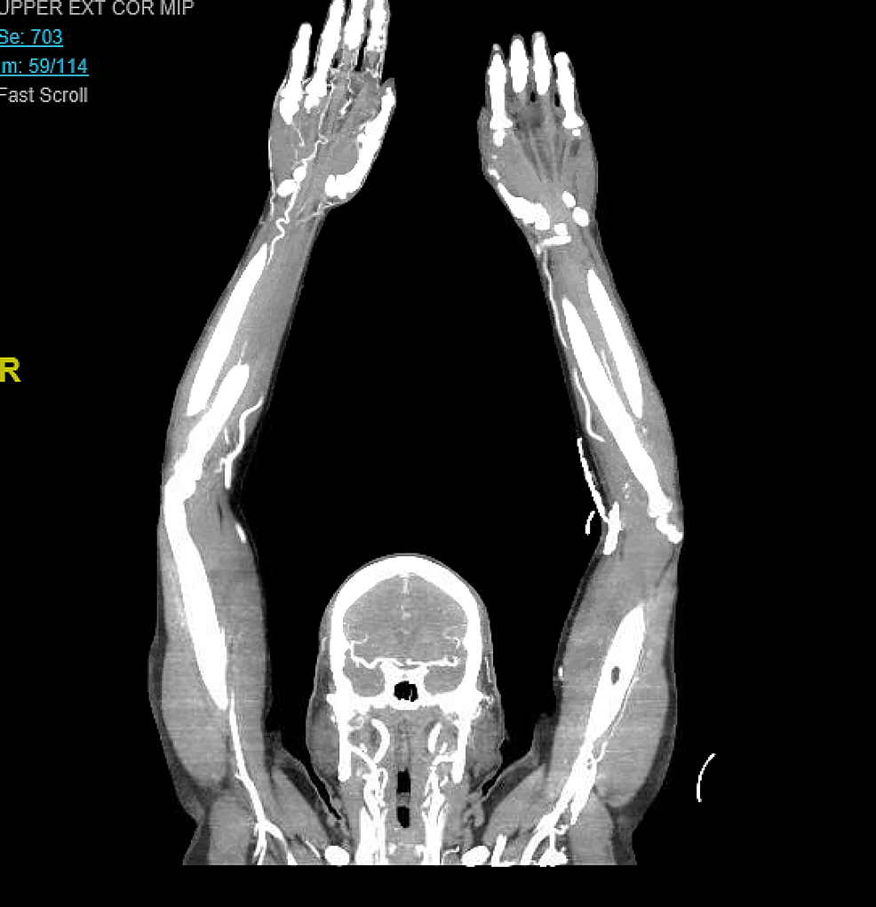 CT Peripheral Angiography - Upper Extremity