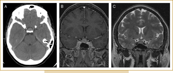 CT Pituitary Fossa