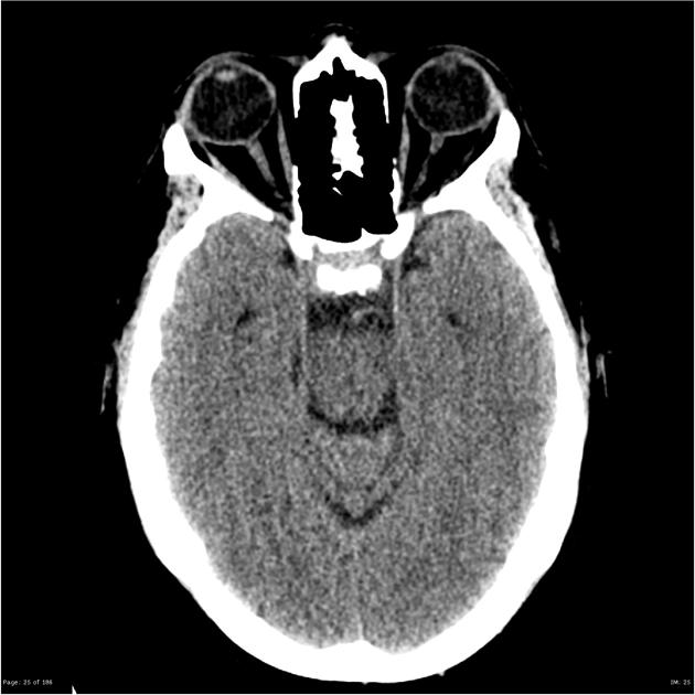 CT Pituitary Fossa