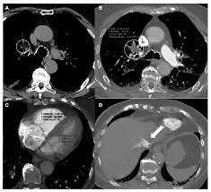 CT Pulmonary Angiography