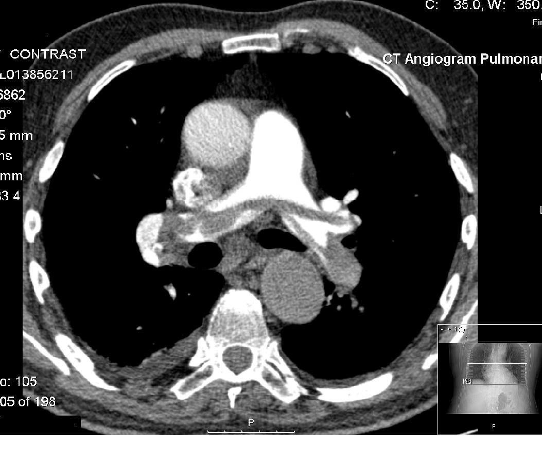 CT Pulmonary Angiography