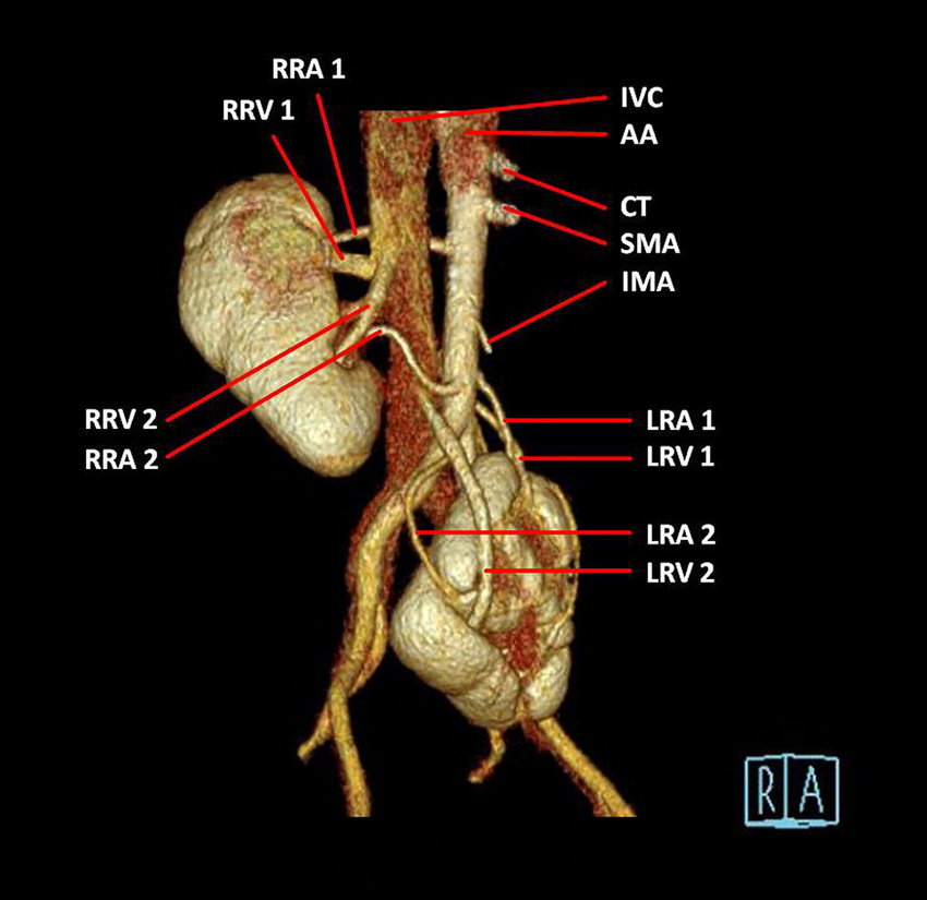 CT Renal Angiography