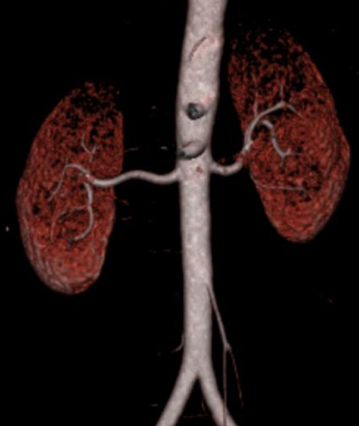 CT Renal Angiography