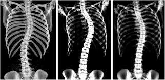 CT SCANOGRAM - SCOLIOSIS