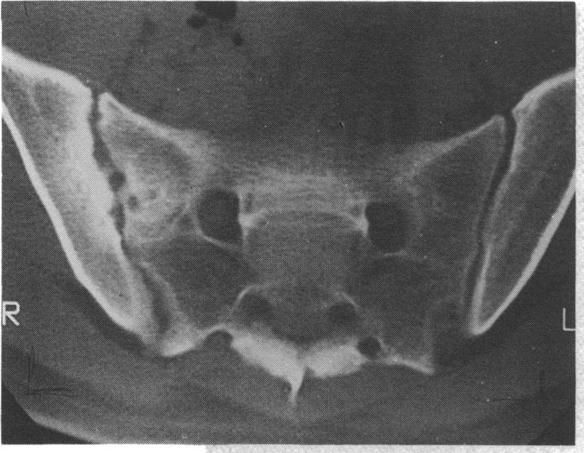 CT Sacro-iliac Joint