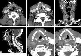 CT Scan Larynx