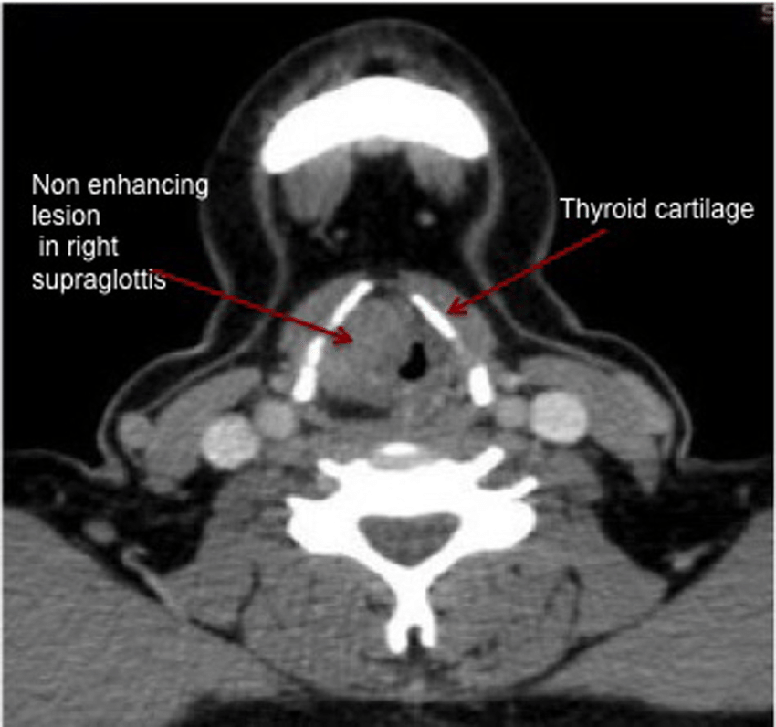 CT Scan Larynx