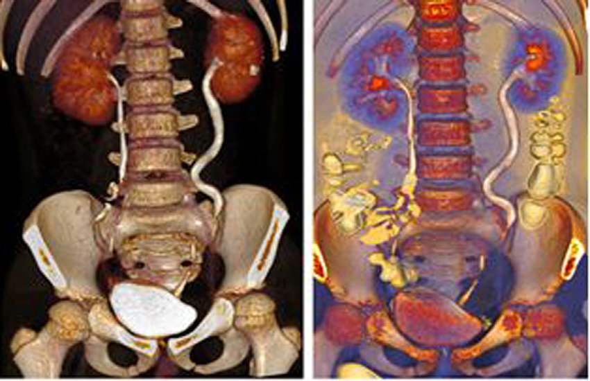 CT Scan Urography