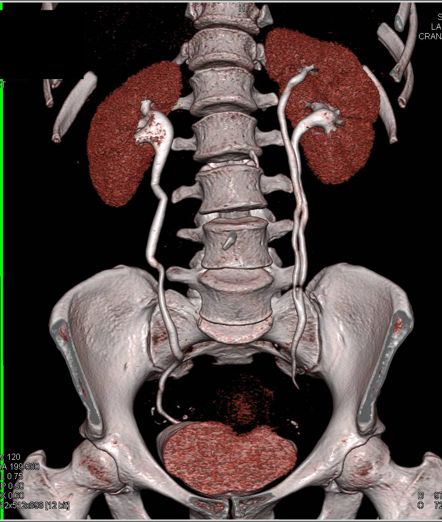 CT Scan Urography