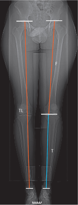 CT Scanogram (Both lower limbs)