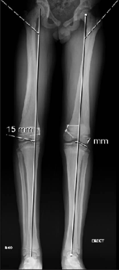 CT Scanogram (Both lower limbs)