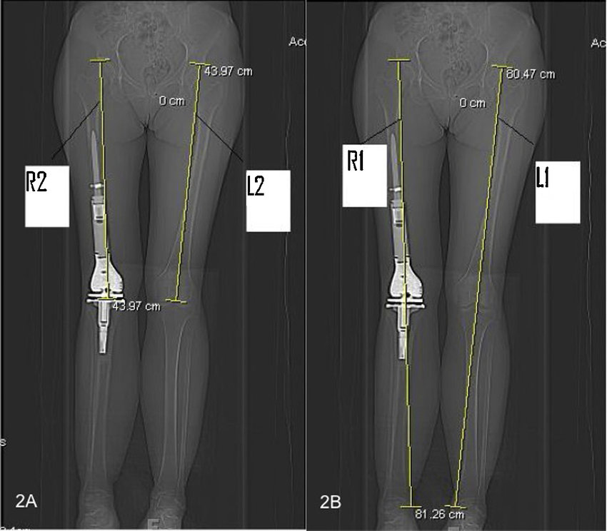 CT Scanogram