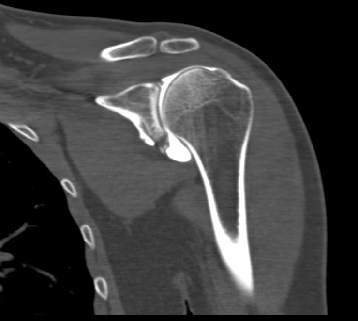 CT Shoulder Joint  LEFT