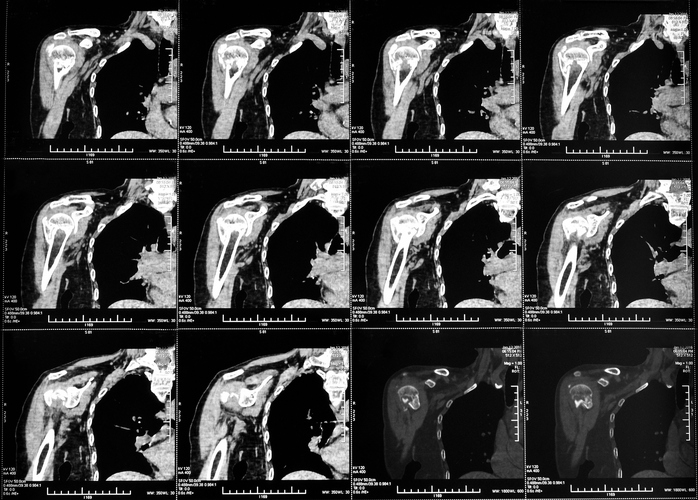 CT Shoulder Joint