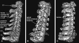 CT Spine (3 Level) Contrast/Plain