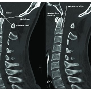 CT Spine (3 Level) Contrast/Plain