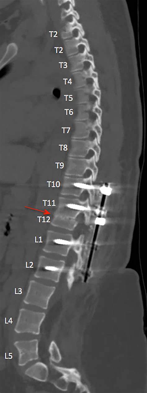 CT Spine