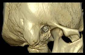 CT Temporal Bone