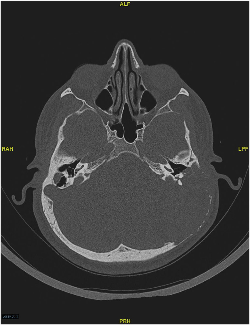 CT Temporal Bone