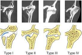 CT Temporo Mandibular Joint