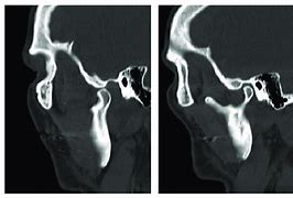 CT Temporo Mandibular Joint