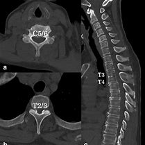 CT Thoracic / Dorsal Spine