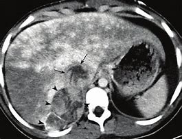 CT Upper Abdomen