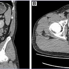 CT Urogram + Cystogram