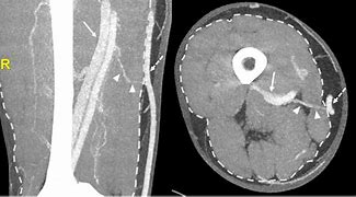 CT Venography (Per Limb)