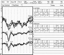 Evoked potential test