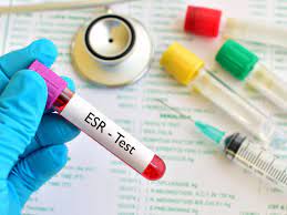 Full Blood Count + Erythrocyte Sedimentation