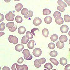 HAEMOLYTIC SCREEN (Total and conjugated BB, DCT, F