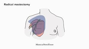 Masectomy