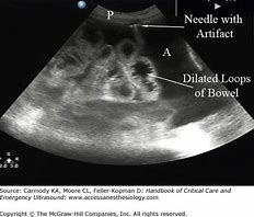 Non-Ultrasound GUided Abdominal Paraestesis