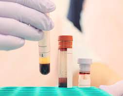 Protein Electrophoresis