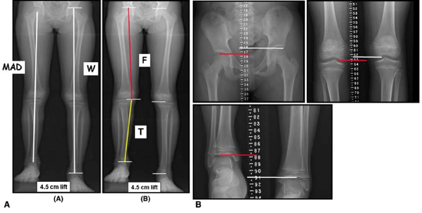 Scanogram Pelvis to Feet AP