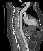 Thoracic Aerta Angiography